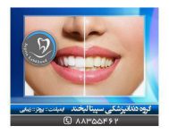 قیمت لمینت دندان