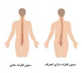 انحراف ستون فقرات