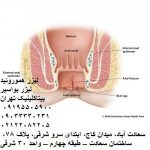 لیزر هموروئید-لیزر بواسیر بیتا کلینیک تهران و بابل-هزینه عمل بواسیر