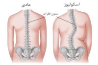 اسکولیوز-چیست؟