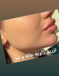 اموزش ژل وبوتاکس